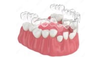 Aligner Treatment Plan