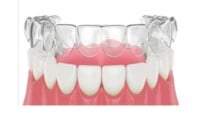 Essix Retainer