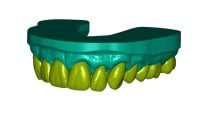 Full Arch Wax-Up