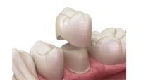 Posterior Crown/Bridge