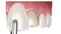 Anterior Crown/Veneer/Bridge
