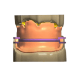 Bite Block