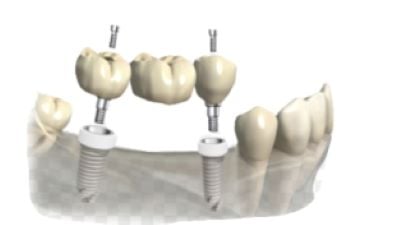 Screw Retained Bridge