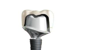 Abutment & Crown