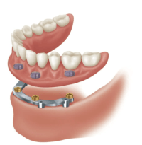 Implant Bars