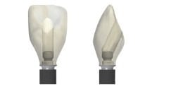 Screw Retained Crown