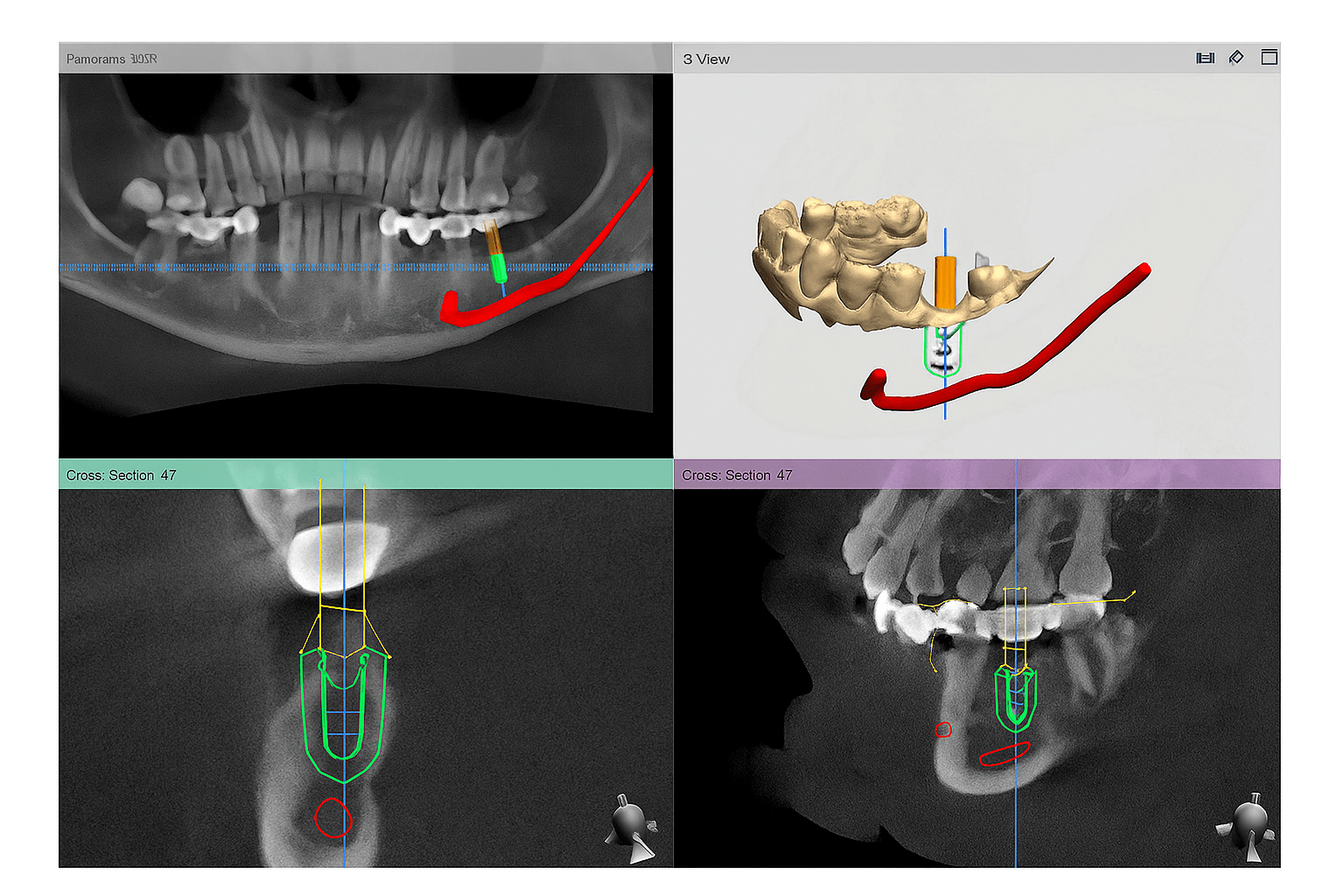 Implant Planning / Surgical Guide RX