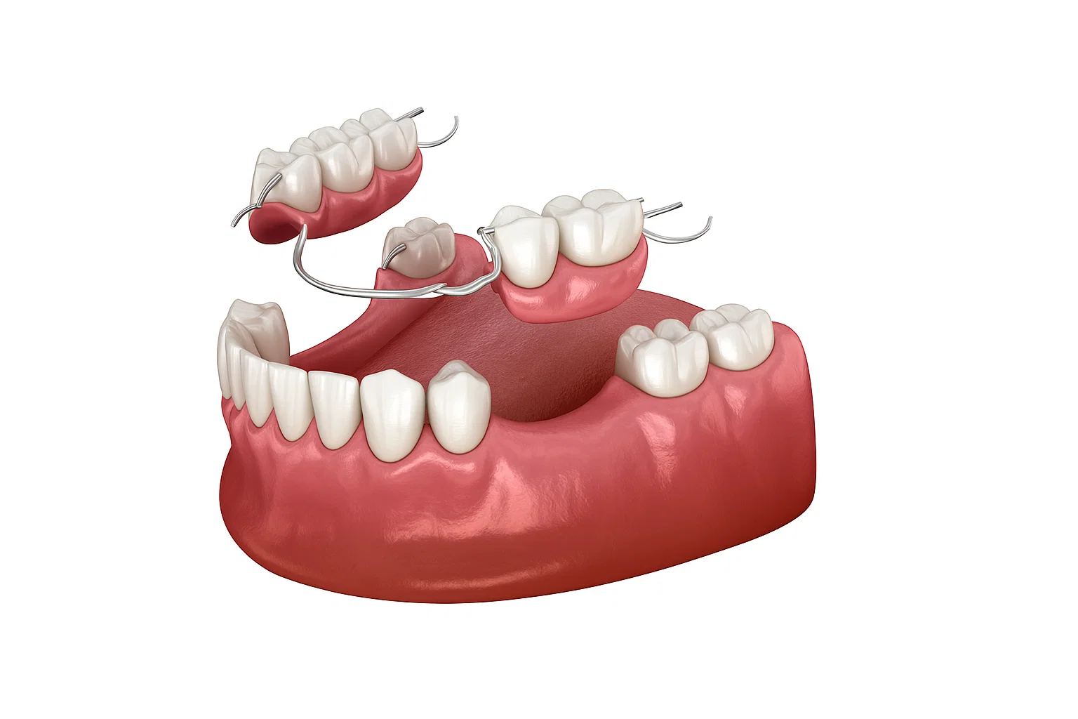 Partial Denture